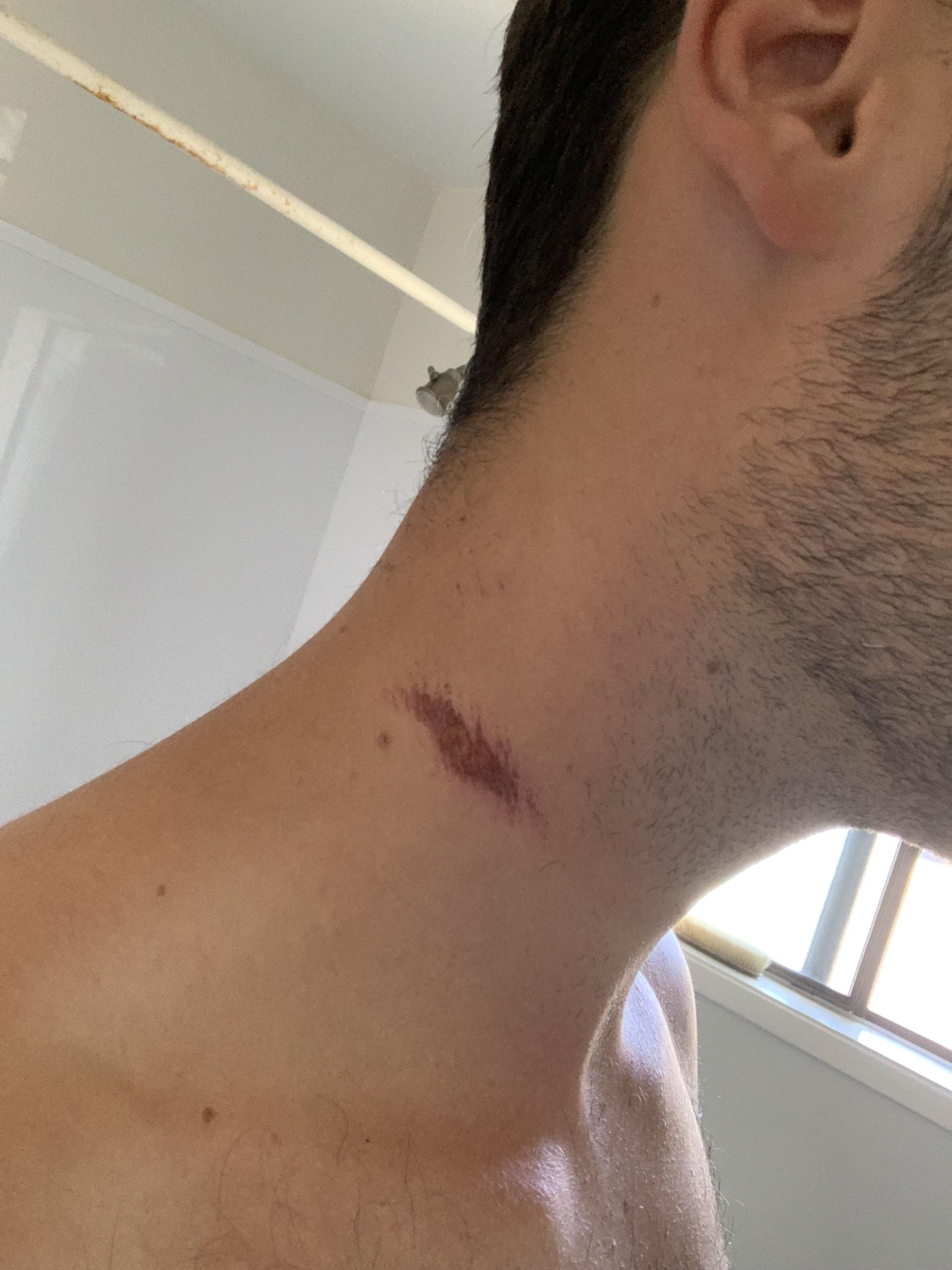 Herida en el cuello con herida superficial y sangre ligera, visible junto a la línea de la mandíbula.