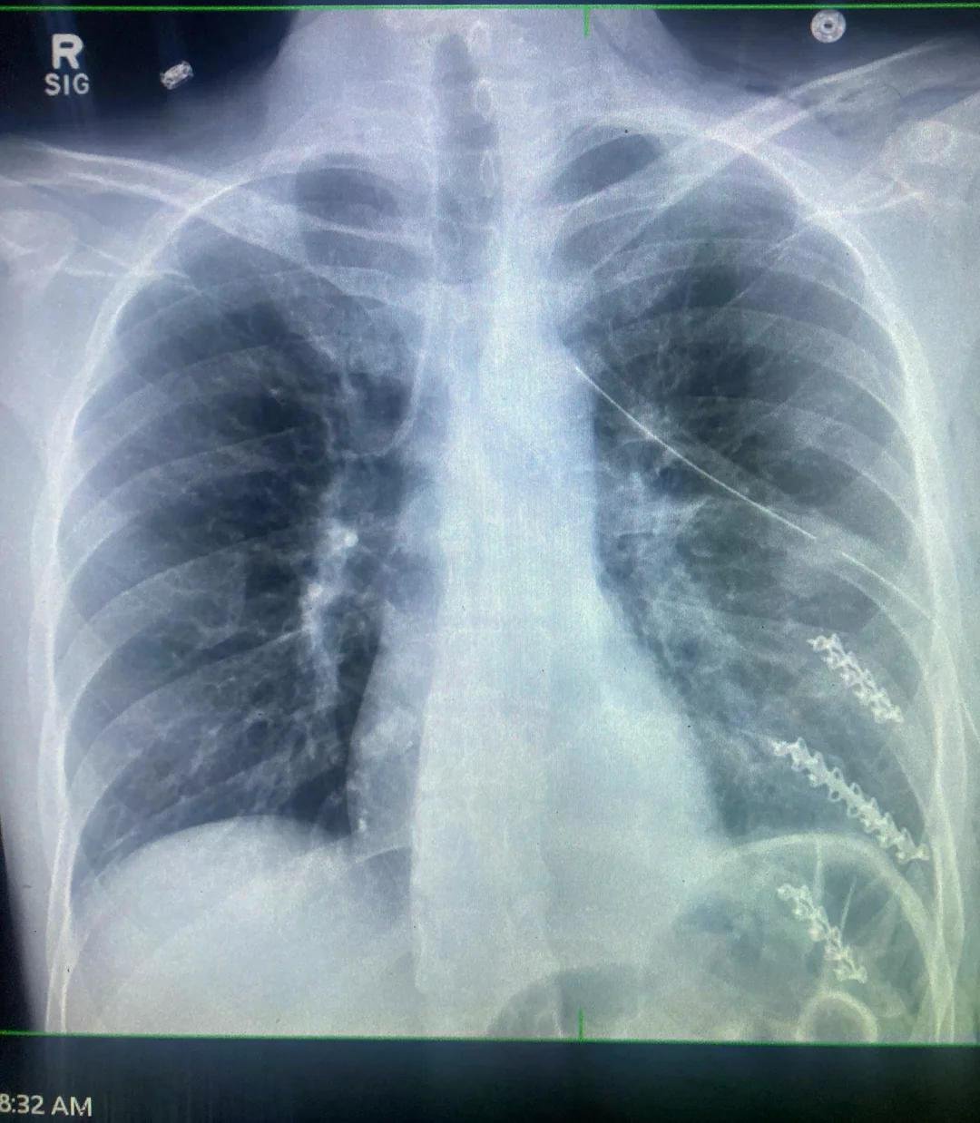 Radiographie pulmonaire montrant les deux poumons et le médiastin, avec contours visibles et quelques zones de densité irrégulière à droite.