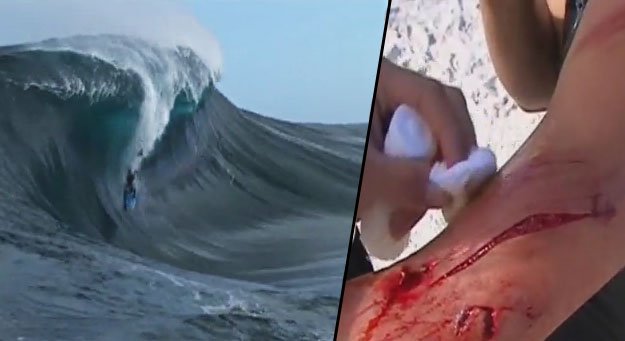 Blessures courantes en bodyboard : comment les prévenir